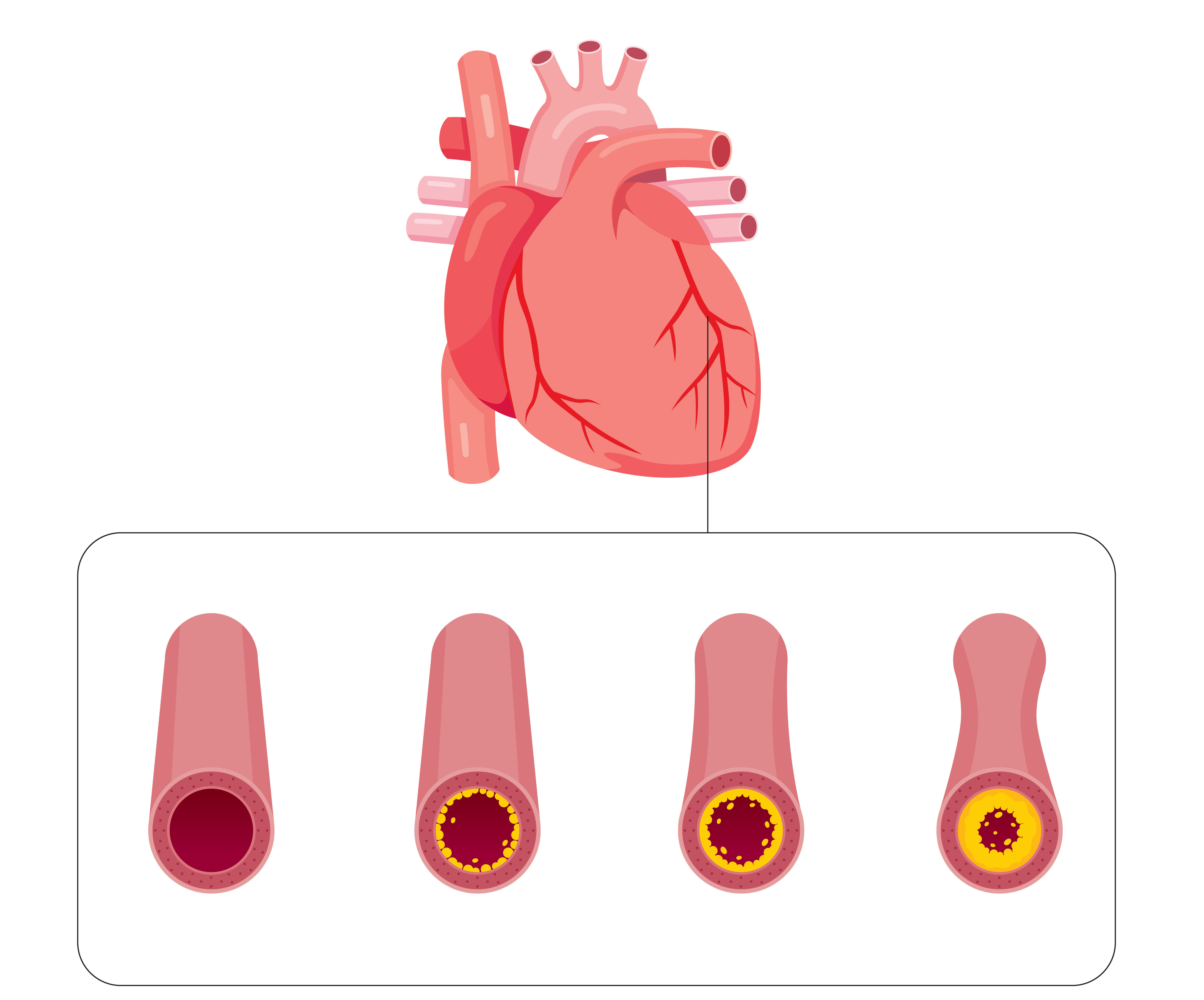 Picture showing Narrowing Or Blockage Of Coronary Arteries, Condition Caused By Build-up Of Cholesterol And Fatty
